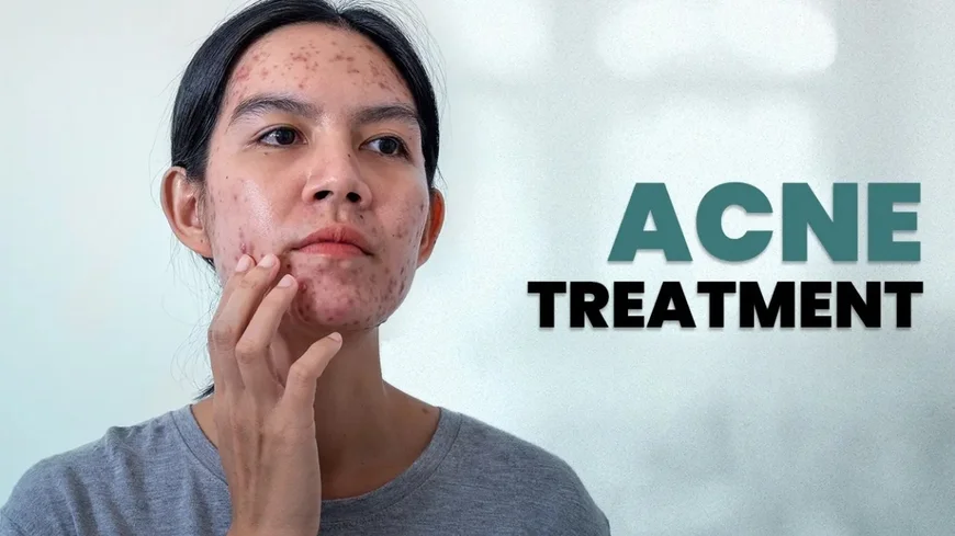 Acne Treatment At Home: एक्ने, पिंपल, ब्लैकहेड और दाग हटाने की पूरी गाइड